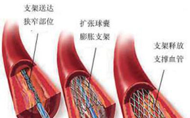 1986年，人类第一例冠脉内支架植入