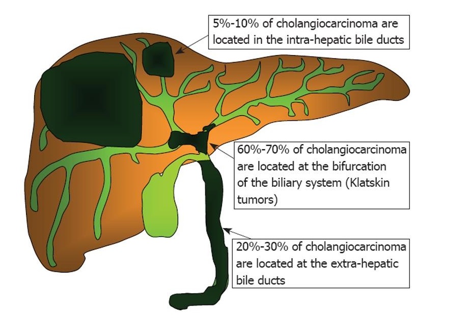 胆管癌.jpg