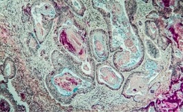 英国NHS批准了晚期肠癌联合免疫疗法