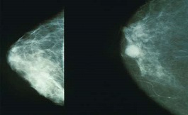 女性之间的乳腺癌死亡率差距缩小了