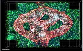 针对活动性肿瘤，海外展开了首次3D生物打印