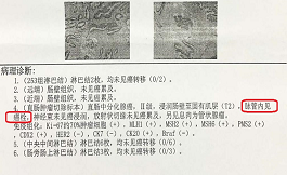 直肠癌术后要不要化疗？