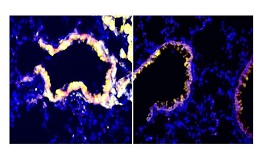 科学家找到了一种逆转肿瘤免疫抑制的新方法