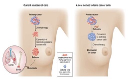 海外发现：侵袭性乳腺癌的新策略
