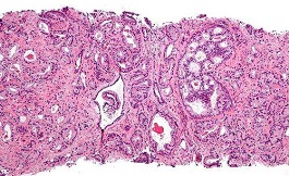 AutoProstate 系统可生成前列腺癌诊断报告