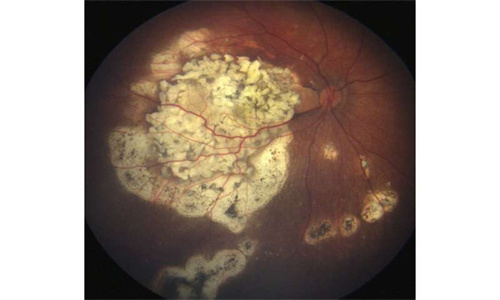 视网膜母细胞瘤.jpg
