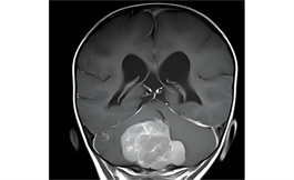 儿童脑瘤：癌细胞在肿瘤内迁移时攻击性降低