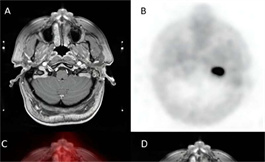 PET/CT 为头颈部副神经节瘤提供了更好的病变检测