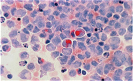 非小细胞肺癌 TROPION-Lung01 研究遗漏了 OS 终点