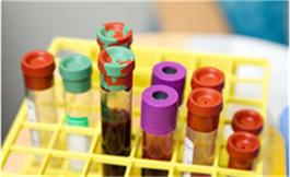 Momelotinib 对骨髓纤维化患者贫血显示出积极影响