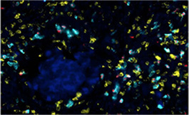数据支持晚期肾细胞癌一线使用 Avelumab 加阿西替尼
