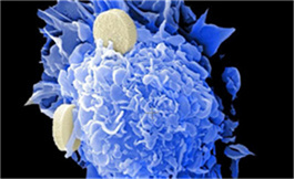 Pembrolizumab 在原发性 UTUC 病变中引起放射反应