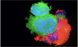 可切除胃癌围手术期 Durvalumab 加化疗符合 EFS 终点