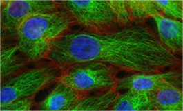 出国看病：dostarlimumab +化疗可适度提高晚期卵巢癌 PFS