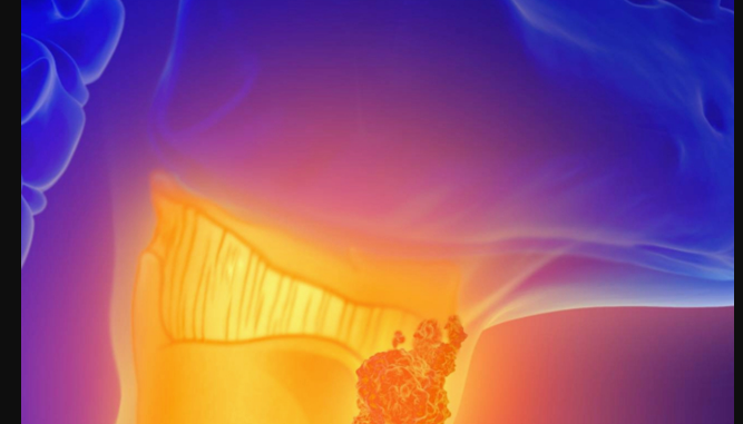 奥德罗奈单抗联合CHOP方案在初治DLBCL患者中展现早期疗效